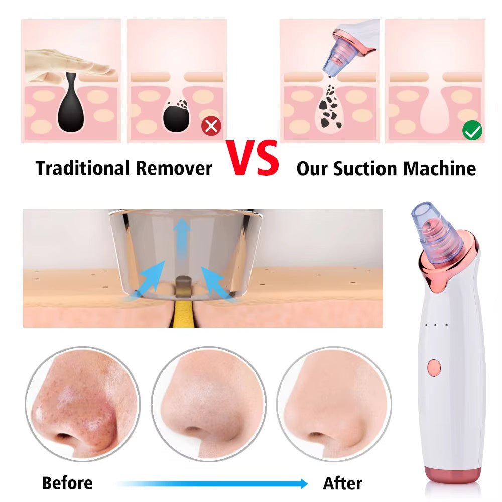 Blackhead Remover Pore Acne Pimple Removal Face T Zone Nose Water Bubble Cleaner Vacuum Suction Facial Diamond Steamer Oil Dirty - WS EMPORIUM